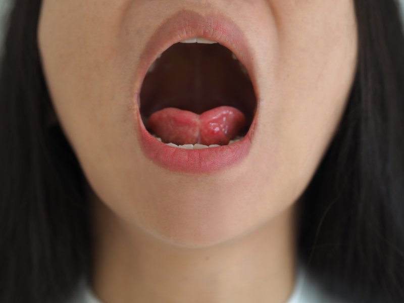 young woman with tongue-tie