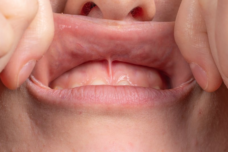 up-close view of a lip-tie